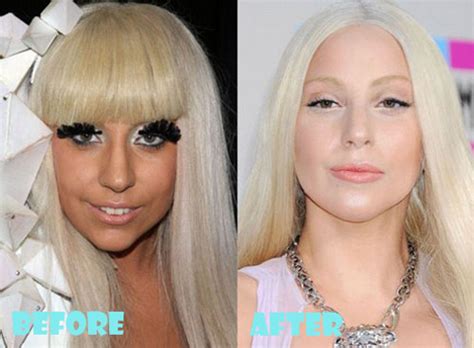 lady gaga surgery|Lady Gaga thanks her fans after surgery on her hip